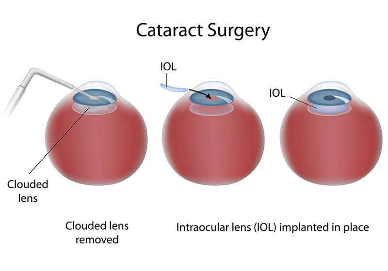 Chart Showing the Cataract Surgery Process