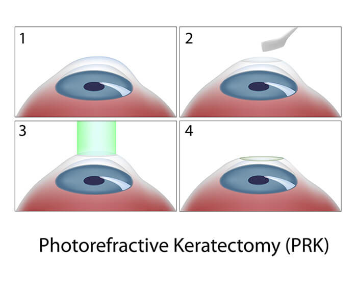 Chart Showing the Process of PRK Surgery